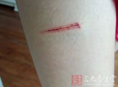 如果仅仅是轻微的表皮擦伤 如果仅仅是轻微的表皮擦伤