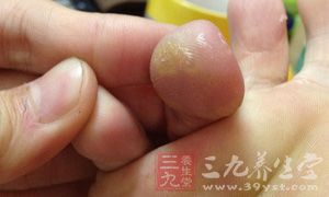 青筋的主要分布在面部、头、脚等部位 青筋的主要分布在面部、头、脚等部位