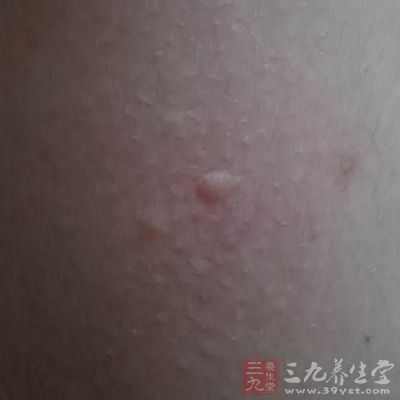 皮膚劃痕蕁麻疹人工蕁麻疹患者