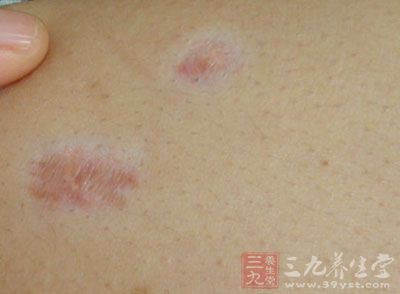 好发于胸、肩、颈、背与耳廓。男女均可发生