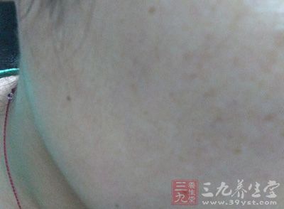 如果你的脸上有痘痘，那么在美丽的女子，也会显得不是那么出色