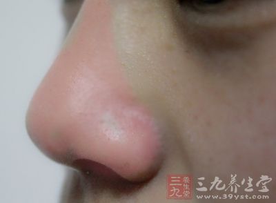 敏感性皮肤者在春季里更容易出现皮肤过敏反应 敏感性皮肤者在春季里更容易出现皮肤过敏反应