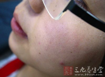 顽固的粉刺，一定也让你很头疼