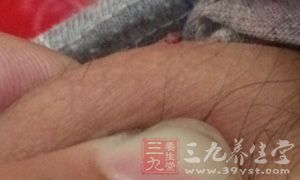 如果发紫或发黑,可能血液循环差 如果发紫或发黑,可能血液循环差