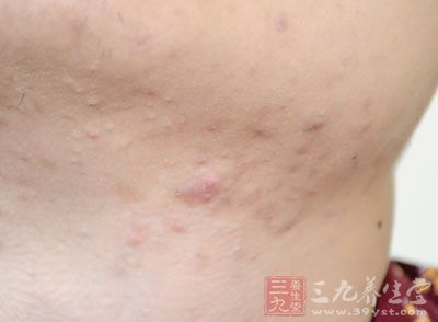 额头长痘:心火旺 额头长痘:心火旺