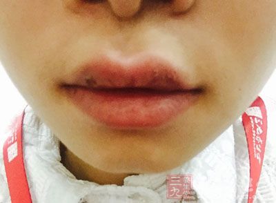 夏日的高温令面部的死皮特别容易堆积 夏日的高温令面部的死皮特别容易堆积