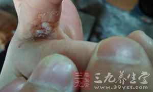 全球每9分钟就有1名新发病例 全球每9分钟就有1名新发病例