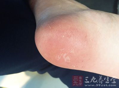 糖尿病足早期症状之周围血管病变