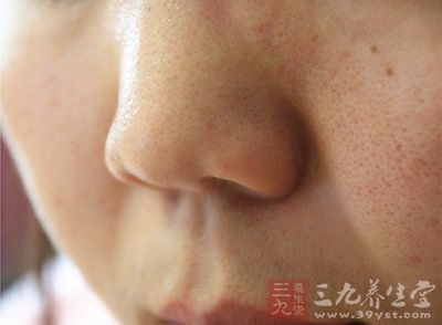 青春期时T区出油严重,长痘痘已成家常便饭 青春期时T区出油严重,长痘痘已成家常便饭