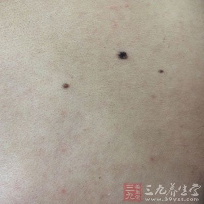 用针挑开黑痣结果震惊众人