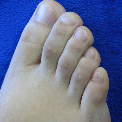 发现脚趾甲有发黄或是趾甲角质层增厚需引起重视