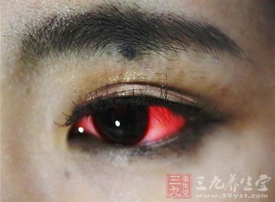 男子眼睛发红误以为是红眼病 实为高血压