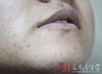 人体内黄体荷尔蒙起着促进分泌皮脂的作用 人体内黄体荷尔蒙起着促进分泌皮脂的作用