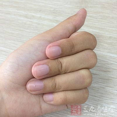 常的手指肿为腱鞘炎