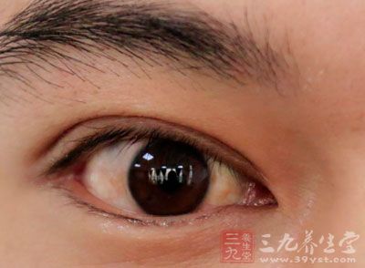 斜视人口_眼睛斜视图片(2)