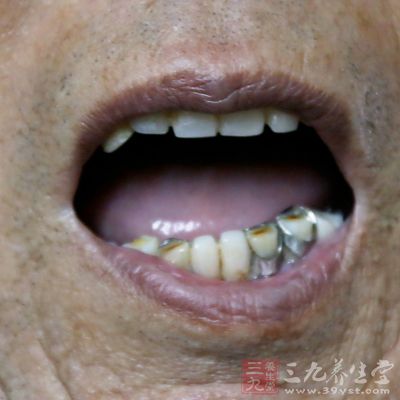 一般成人牙齿的数量应该在28颗~32颗之间 一般成人牙齿的数量应该在28颗~32颗之间