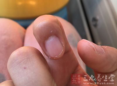 指甲横纹多由营养缺乏引起