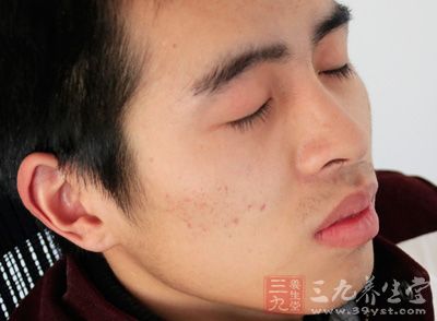 生长在嘴唇或其周围的小水泡,传染性极高 生长在嘴唇或其周围的小水泡,传染性极高