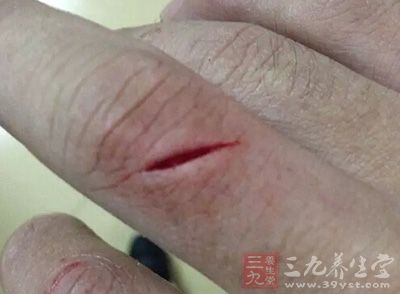 小伤口不及时处理危害大 小伤口不及时处理危害大