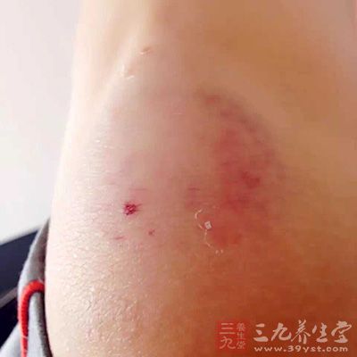 伤口的愈合,必须有“氧” 伤口的愈合,必须有“氧”