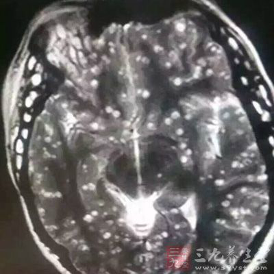 常吃生肉迪庆少女全身长虫 医生提醒:不提倡吃生肉 常吃生肉迪庆少女全身长虫 医生提醒:不提倡吃生肉