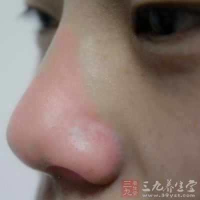 表现在鼻头部皮肤发红，且有许多毛细血管网，俗称红鼻子
