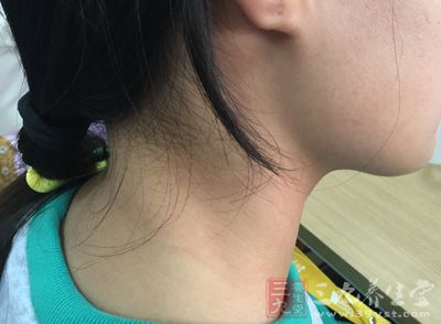 脖子粗,血管差 脖子粗,血管差