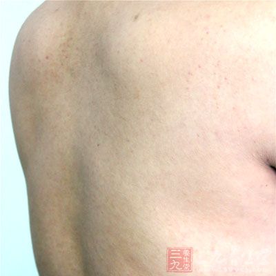 后背上的痘痘大多是由于皮脂分泌过旺引起的