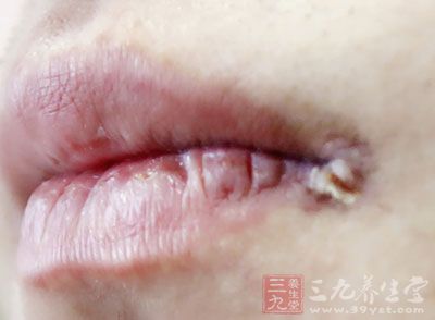 防治唇干的日常护理