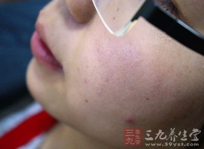 一旦脸上长了几颗痘痘,很多人都会想要把它挤掉 一旦脸上长了几颗痘痘,很多人都会想要把它挤掉