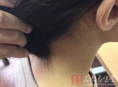 脖子上长小肉疙瘩的现象大家在平时应该见过的不是很多 脖子上长小肉疙瘩的现象大家在平时应该见过的不是很多