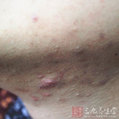 正面认识挤痘成瘾这件事情 正面认识挤痘成瘾这件事情