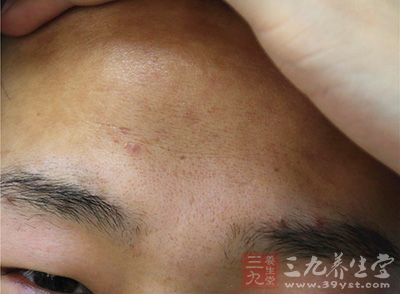 随手挤个痘竟得败血症 随手挤个痘竟得败血症