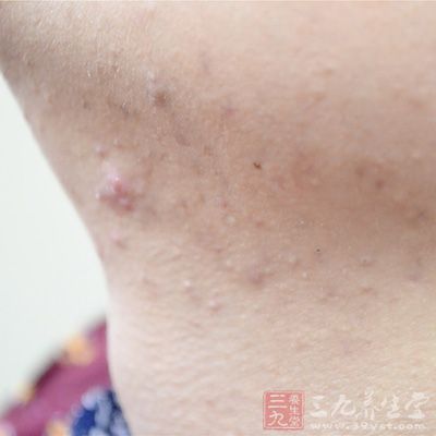 医院主任中医师面部、后脖颈起一些痤疮都跟炎症有关 医院主任中医师面部、后脖颈起一些痤疮都跟炎症有关