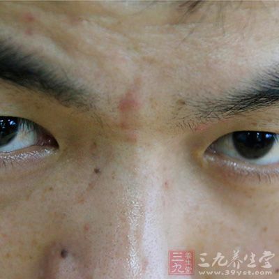 用手去挤 挑痘痘有哪些危害呢 用手去挤 挑痘痘有哪些危害呢