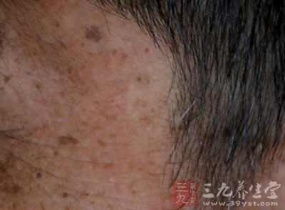 大笑时出现的表情纹 大笑时出现的表情纹