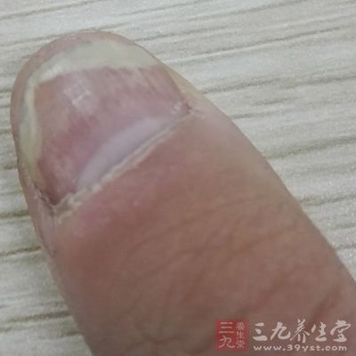 脚指甲变厚怎么治 如何治疗脚指甲变厚(2)