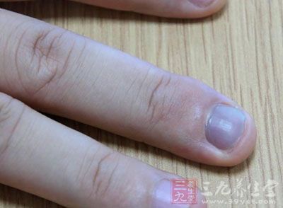 腳氣灰指甲怎么根治 分析病癥對(duì)癥下藥