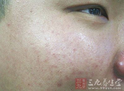 你正与青春痘酣战