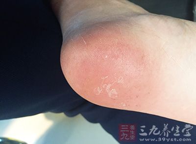 可以用温热的水泡脚 可以用温热的水泡脚