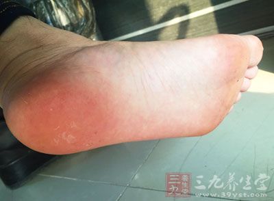 腳氣怎么辦 腳氣與腳氣病是一回事嗎