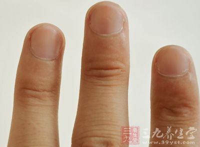 灰指甲的初期症状 这7个因素让指甲病变