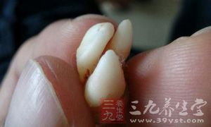 拔智齿瘦脸的说法由来已久 拔智齿瘦脸的说法由来已久