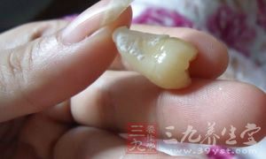 智齿是后萌出的牙 智齿是后萌出的牙