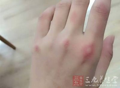 被咬伤后,应立即用肥皂水,石灰水洗涤伤口,如在野外可用鲜蒲公英或