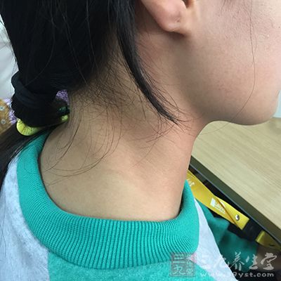 随着年龄的增长,颈部的皮肤变得老化松弛 随着年龄的增长,颈部的皮肤变得老化松弛