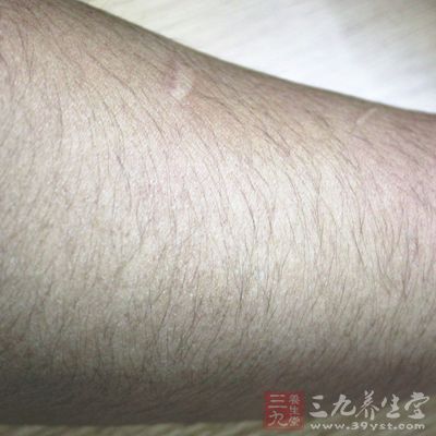 脱毛区的皮肤不要暴晒 脱毛区的皮肤不要暴晒