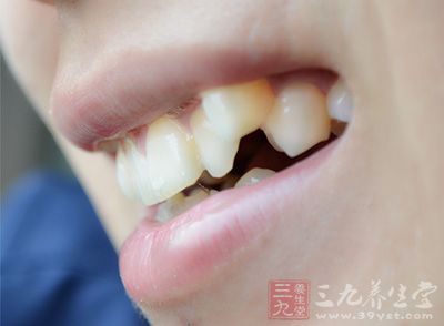 牙齿很黄,不好意思张嘴笑怎么办 牙齿很黄,不好意思张嘴笑怎么办