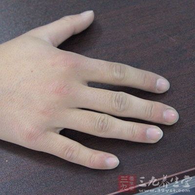 指甲反应健康 教你如何从指甲看疾病(2)
