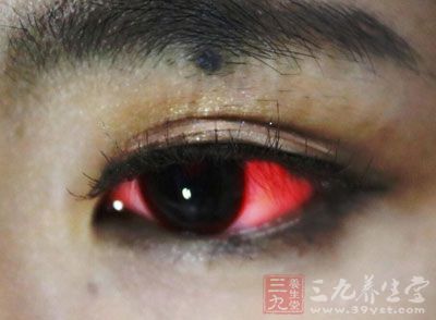 眼睛里有红血丝 如何去除红血丝